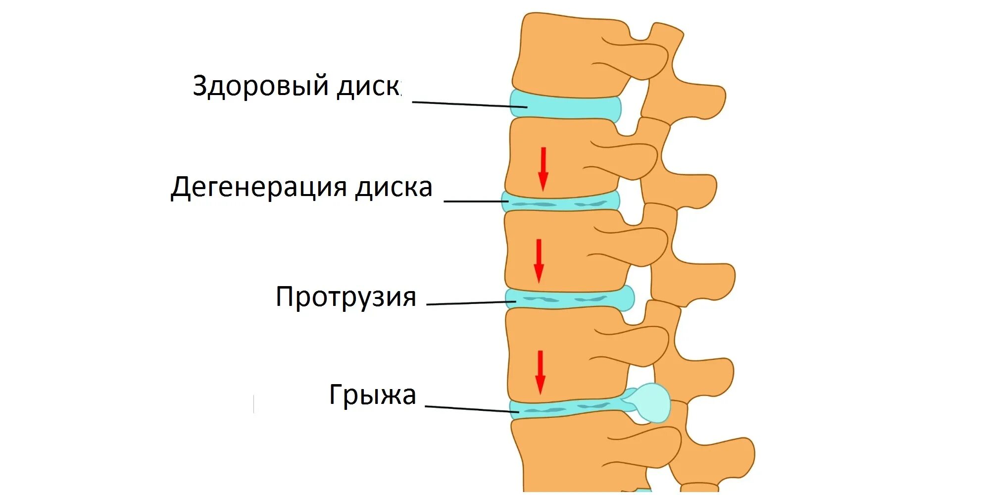 Протрузия межпозвоночного диска поясничного