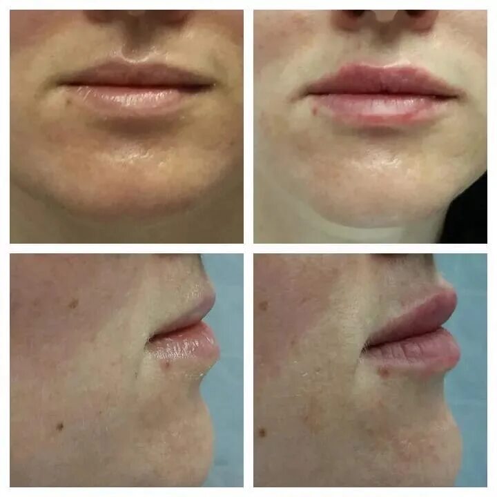 Рассасывание филлера. Биоревитализация губ гиалуроновой кислотой эффект. Биоревитализация губ до и после. Ботокс в верхнюю губу до и после.