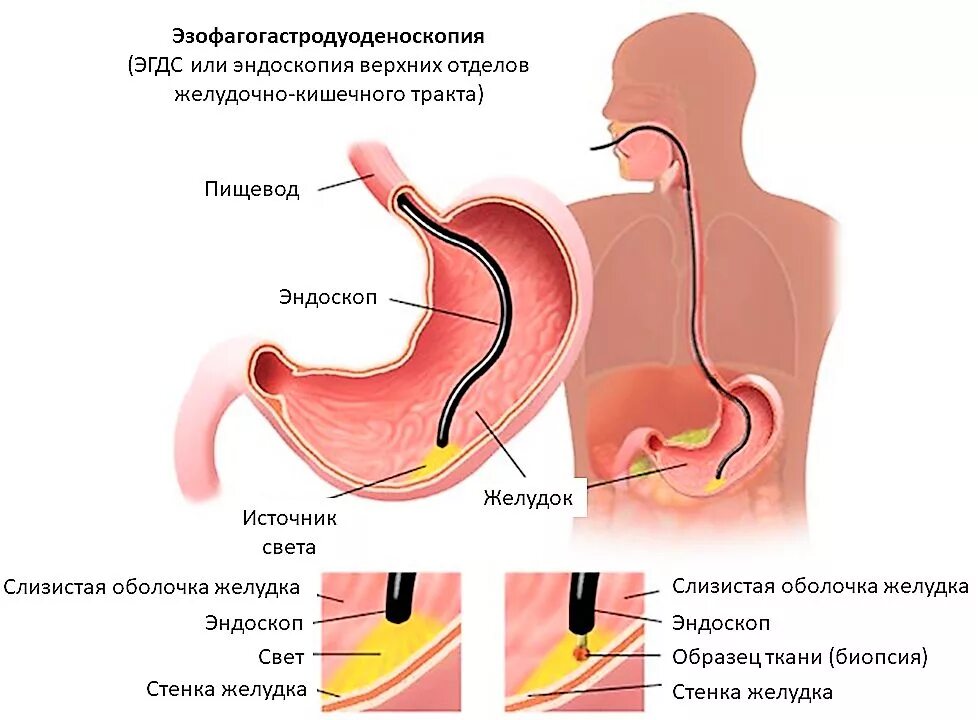 Пищевод б. Язвенная болезнь желудка ФГДС. Гастроэзофагеальная-рефлюксная болезнь ФГДС. Гастроскопия (ЭГДС, ФГДС).