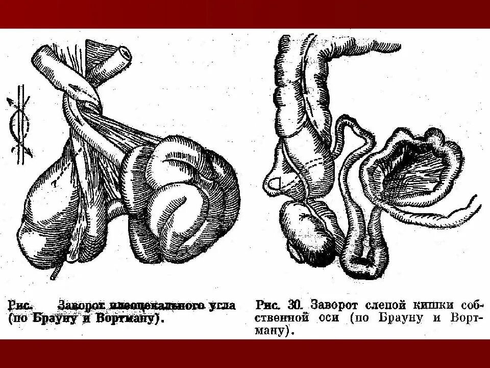 От чего может быть заворот. Илеоцекальный заворот. заворот толстой кишки рентген.
