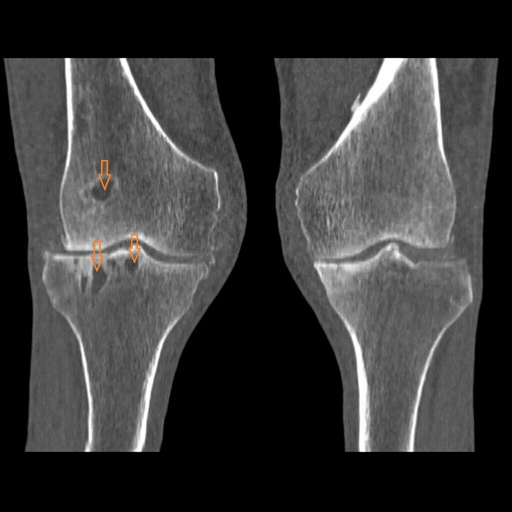 Артрит кт. Деформирующий артроз коленного сустава рентген. Гонартроз коленного сустава 1. Гонартроз коленного сустава рентген. Остеоартроз коленного сустава рентген.