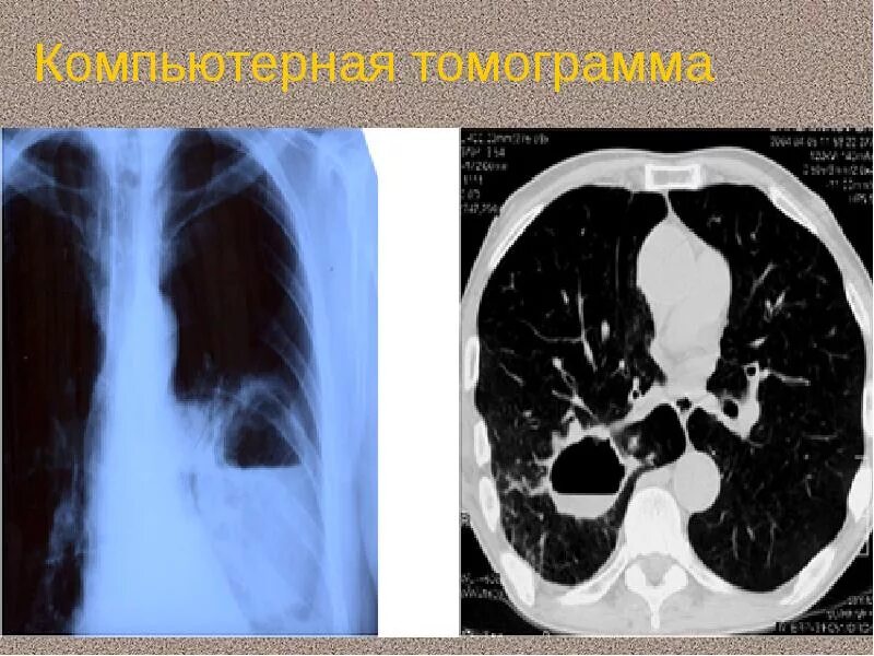 Абсцесс и гангрена легкого. Рентгенография гангрены легкого. Дренированный абсцесс кт. Гангренозный абсцесс легкого кт. Гангрена легкого рентген.