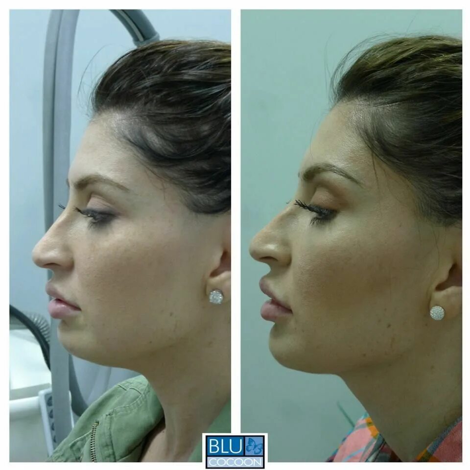 Pin on Orthognathic Jaw Surgery Jaw surgery, Double jaw surgery, Plastic surgery