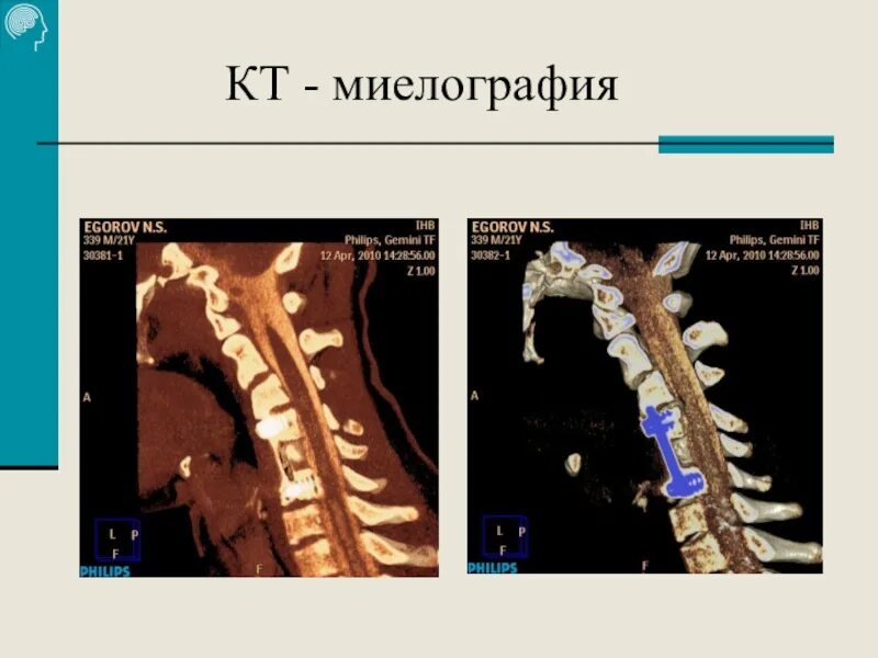 Ран мозга бехтеревой. Кт миелография позвоночника. Миелография мрт. Кт миелография. Миелография позвоночника что это такое.