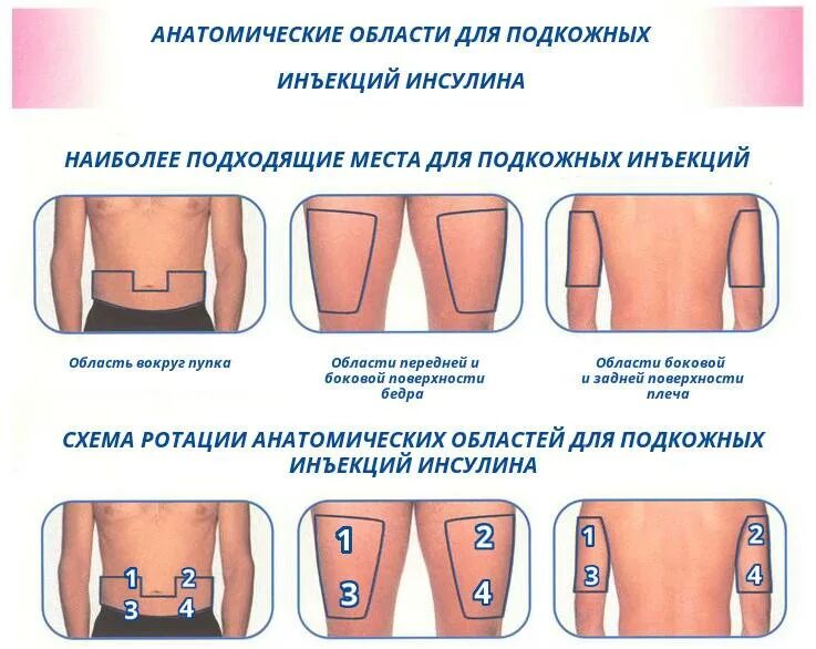 После инъекции инсулина пациент. Анатомические области введения инсулина. Алгоритм введения подкожной инъекции в живот. Области подкожного введения инсулина. Техника введения инсулина для пациентов.