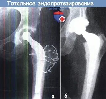 Эндопротезирование тазобедренного сустава код по мкб