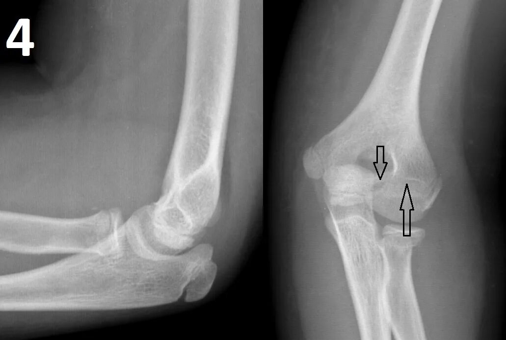 Локтевой сустав рентген норма у детей. Перелом локтевого отростка локтевой кости. Рентген локтевого сустава в норме у детей 5 лет. Локтевой сустав рентгенограмма норма.