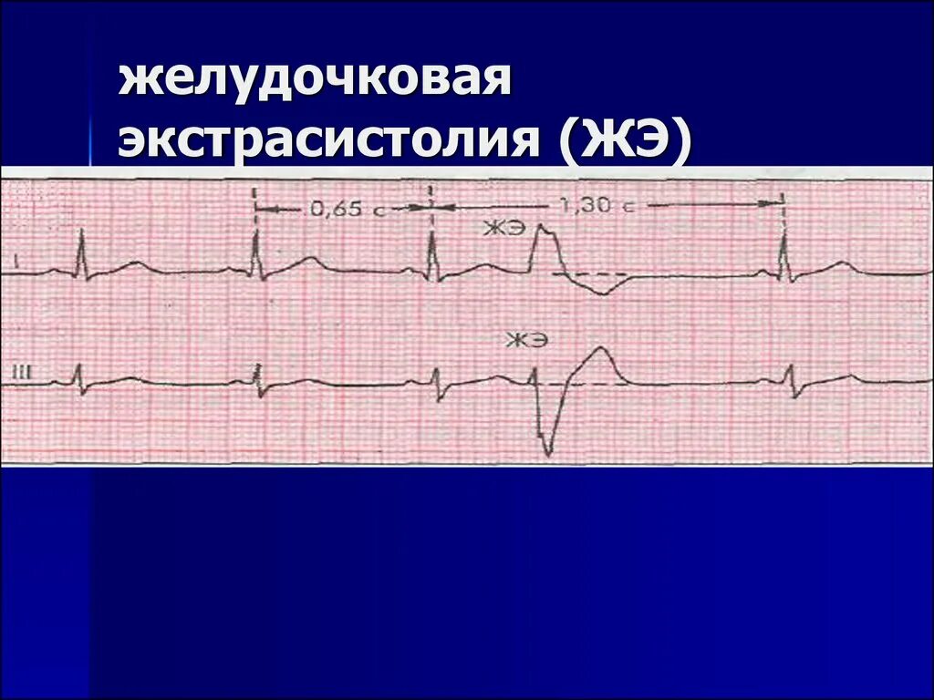 Желудочные экстрасистолы