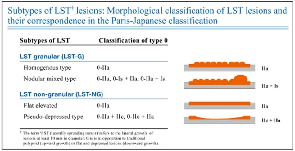 Тип 0 is. LST полипы классификация. Парижская классификация LST. LST эндоскопия классификация. LST опухоли классификация.