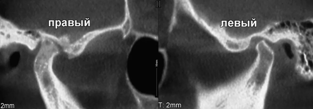 артрит височно-нижнечелюстного сустава. артроз верхнечелюстного сустава. внчс костные структуры. артроз внчс классификация. ревматоидный артрит внчс кт.
