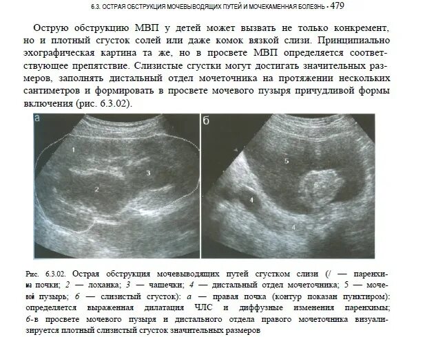 Диффузные изменения левой почки. Микролиты на УЗИ. Микролиты и камни в почке УЗИ. Микролиты в почках на УЗИ. Микролитиаз почек УЗИ.