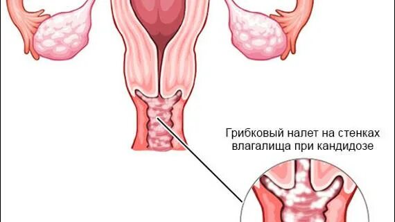 Молочница во время беременности 1 триместр. Кандидоза при беременности 3 триместр. молочница у беременных 2 триместр. кандидоз во 2 триместре. молочница у беременных 1 триместр.