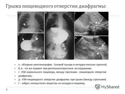 Грыжа пищевода узи