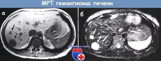 Гемангиома печени печени кт. Гемангиома печени на кт с контрастированием. Капиллярная гемангиома печени мрт. Капиллярная гемангиома печени на кт. Очаговые гемангиомы печени