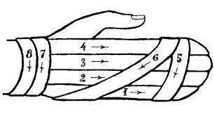 Техника наложения варежки
