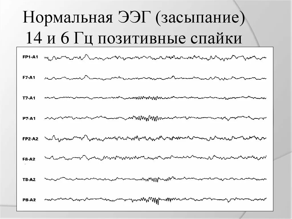 ЭЭГ показания. Показания энцефалограммы. Нормальная электроэнцефалограмма. Спайк на ээг