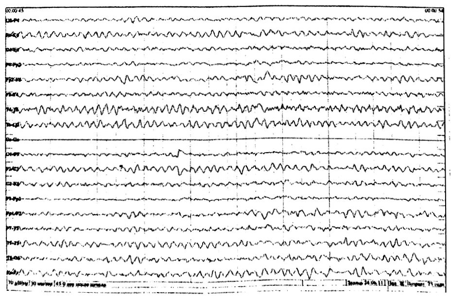 Умеренные изменения бэа мозга. Дезорганизация основного ритма ЭЭГ. Диффузные изменения на ЭЭГ. Выраженные диффузные изменения БЭА головного мозга. ЭЭГ легкие диффузные изменения.