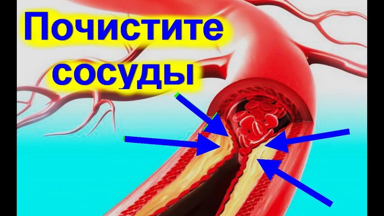 Как открыть сосуды. Очищение кровеносных сосудов. очистить кровеносные сосуды. чистка кровяных сосудов. атеросклероз чистка сосудов.