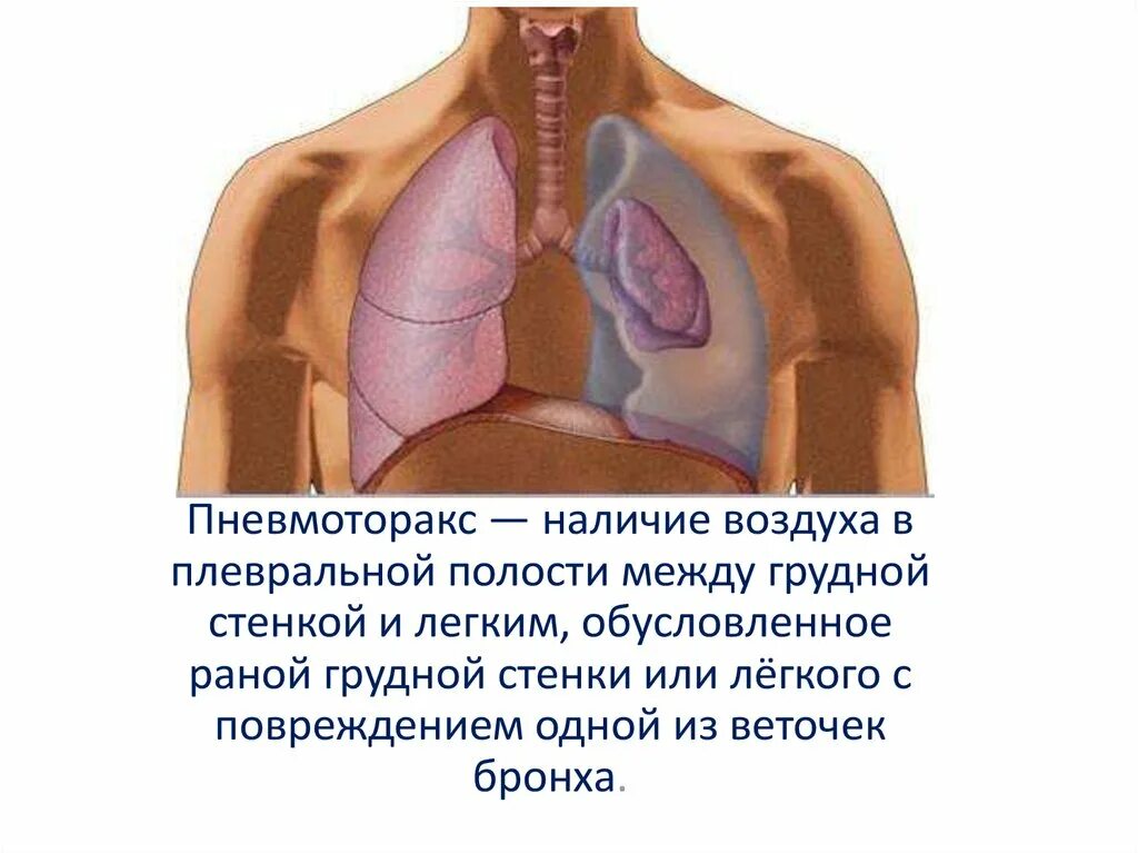 1 помощь при закрытом пневмотораксе. Пневмоторакс и гемоторакс. При закрытом пневмотораксе. Пневмоторакс ПМП.