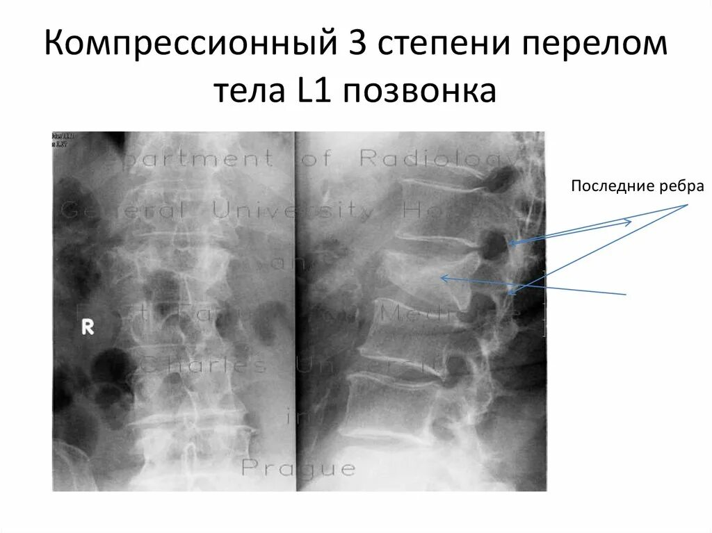 Неосложненный компрессионный перелом тела l2 позвонка. Компрессионный перелом позвоночника th-5-6. Компрессионный перелом тела позвонка степени рентген. Компрессионный перелом позвоночника 1 степени поясничного отдела. Компрессионный перелом тела 1 1