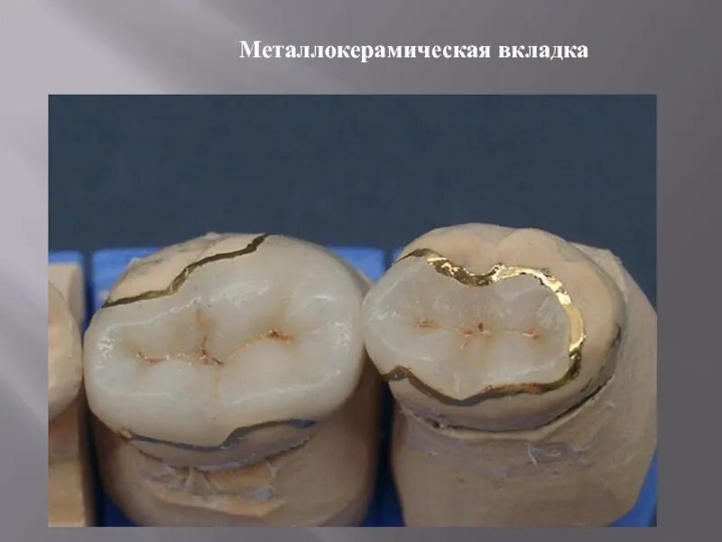 Керамические вкладки emax. Литые культевые штифтовые вкладки. Культевая вкладка штифт зуб. Как выглядит вкладка. Цельнокерамическая накладка emax.