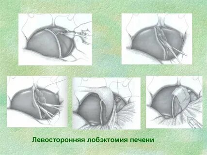 Какие операции на печени