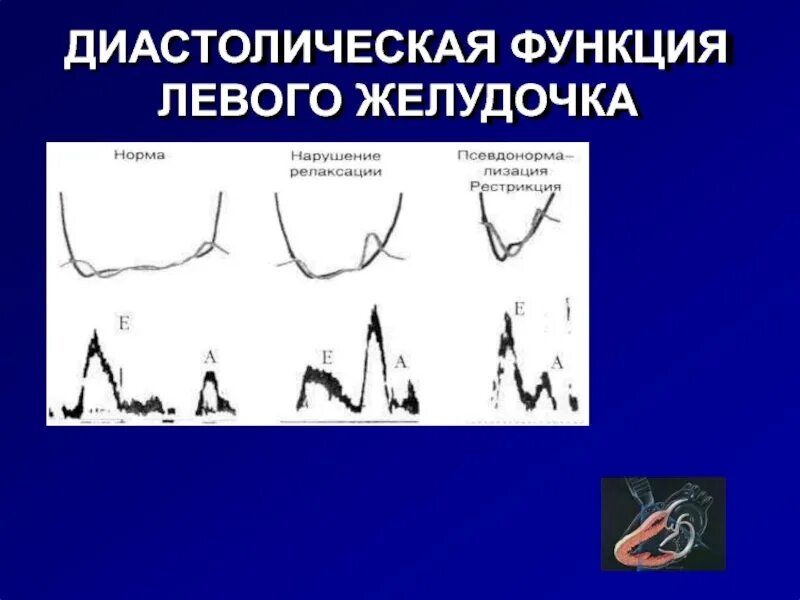 Типы нарушения диастолической функции лж. Диастолическая дисфункция левого желудочка е/а. Диастолическая функция левого желудочка. Систолическая и диастолическая функция левого желудочка.