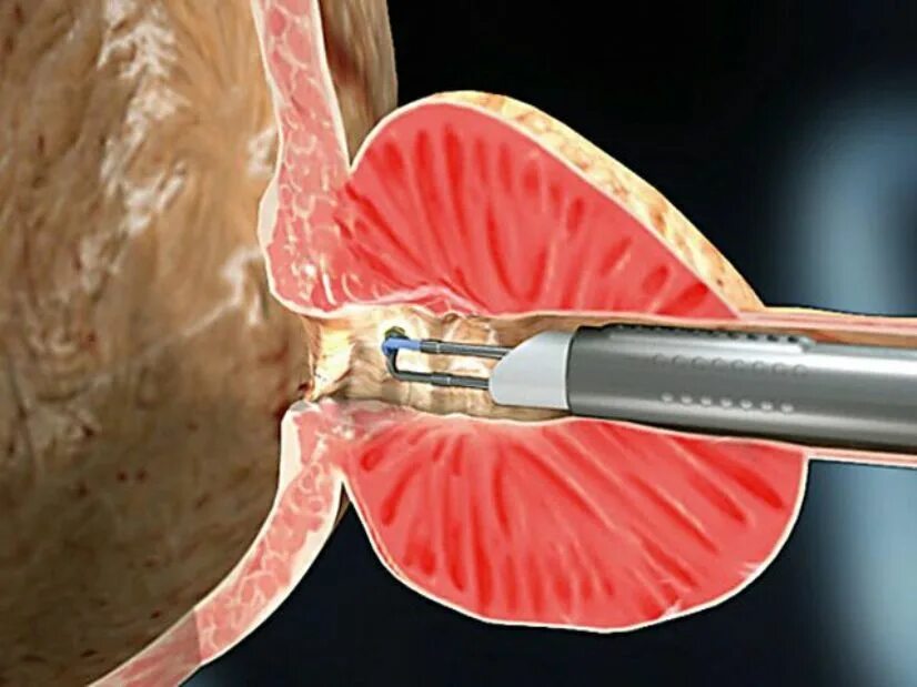 Трансуретральная резекция аденомы простаты. Лазерная вапоризация простаты. Лазерная вапоризация аденомы предстательной железы. Лазерная деструкция (вапоризация).
