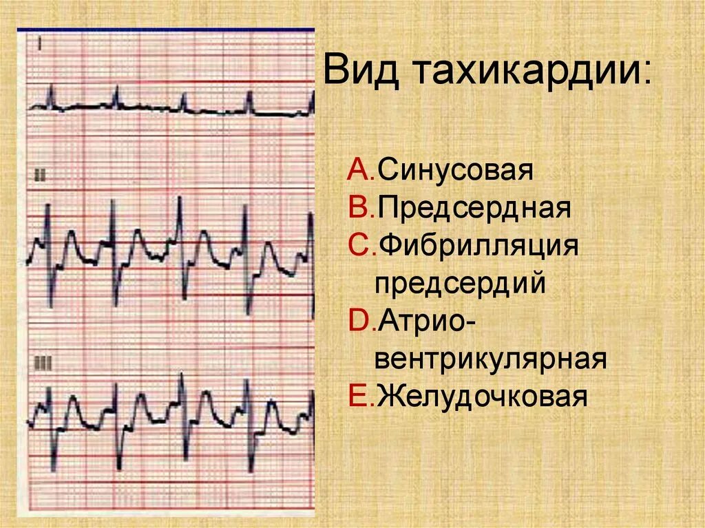 Чем отличается аритмия от тахикардии. Виды тахикардии. синусовая и предсердная тахикардия. фибрилляция предсердий и тахикардия.