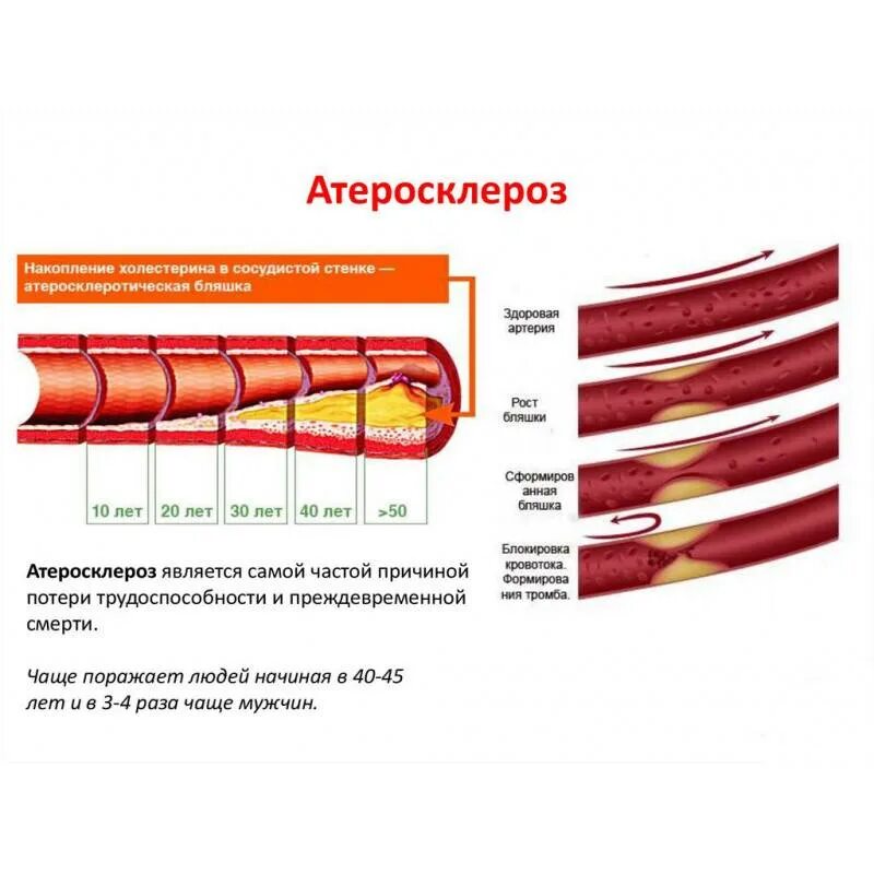 Препараты для очистки сосудов от холестериновых бляшек. Для очищения сосудов препараты от холестериновых бляшек. Таблетки для очищения сосудов от холестерина. Таблетки для очистки сосудов от тромбов. Как проверить сосуды на тромбы и холестериновые