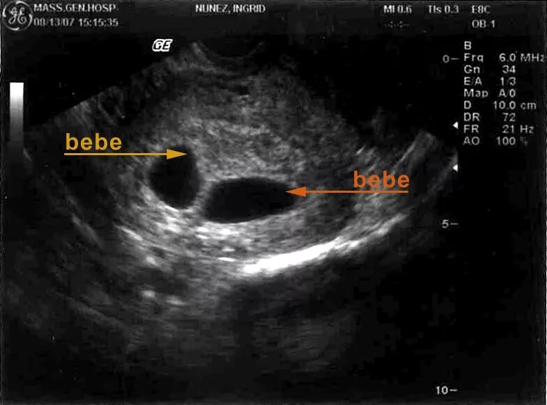 Двойня 5 недель беременности. УЗИ двойни на 5 акушерской неделе беременности. УЗИ 5-6 недель беременности двойня. УЗИ 7 недель беременности двойня. УЗИ 8 недель беременности двойня.