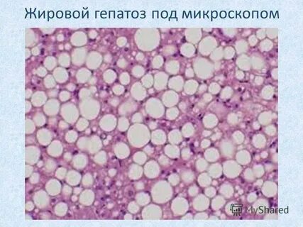 Алкогольная жировая дистрофия