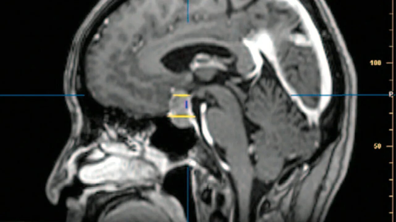 Гипофиз в голове. Аденома гипофиза мрт. Микроаденома гипофиза мрт. Микропролактинома гипофиза на мрт. Гипофиз на кт в норме.
