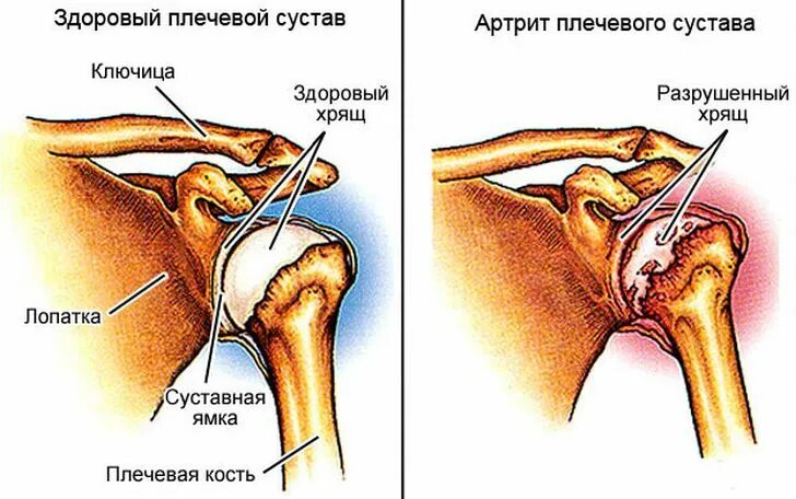 Почему болит сустав плеча. Реверсивный эндопротез плечевого сустава. Артрит плечевого сустава. Артроз плечевого сустава.