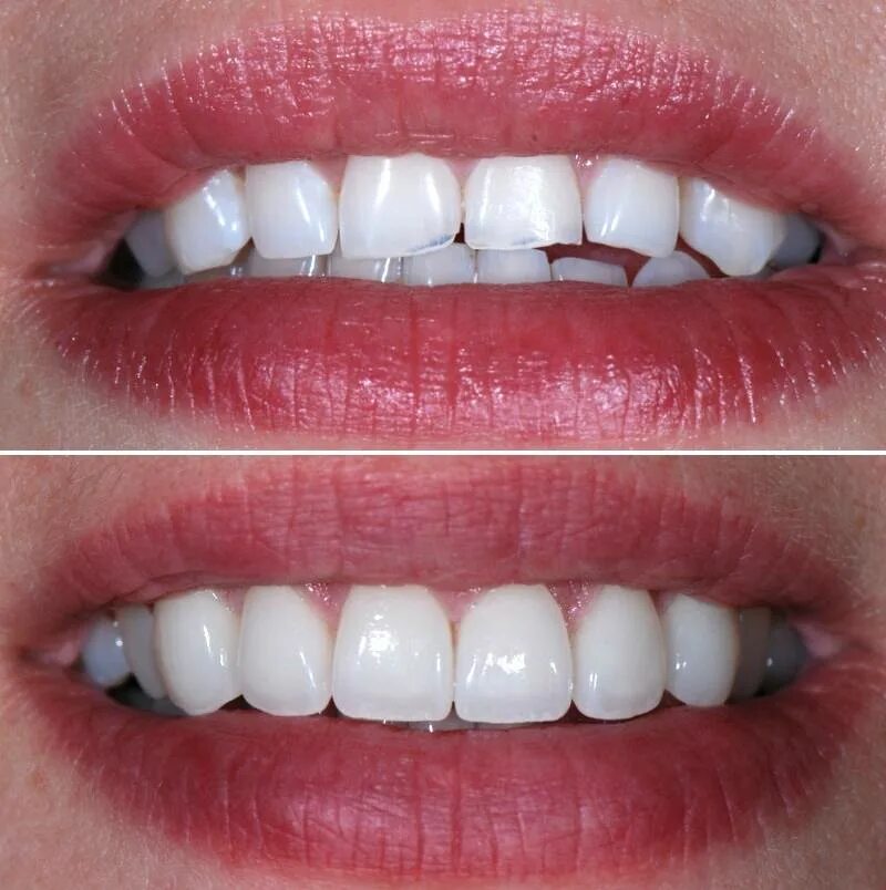 Диоксид циркония мостовидный протез. Металлокерамическая коронка а1 120. Фарфоровые коронки на зубы. Как выглядят керамические зубы. Цельнокерамическая коронка emax.