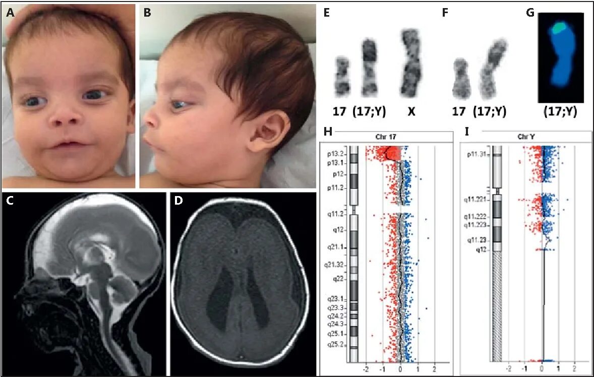 Миллера дикера. Миллера-Дикера лиссэнцефалия. Синдром по 17 хромосоме. Синдром ди Джорджи хромосомы. Синдром ди Джорджи кариотип.