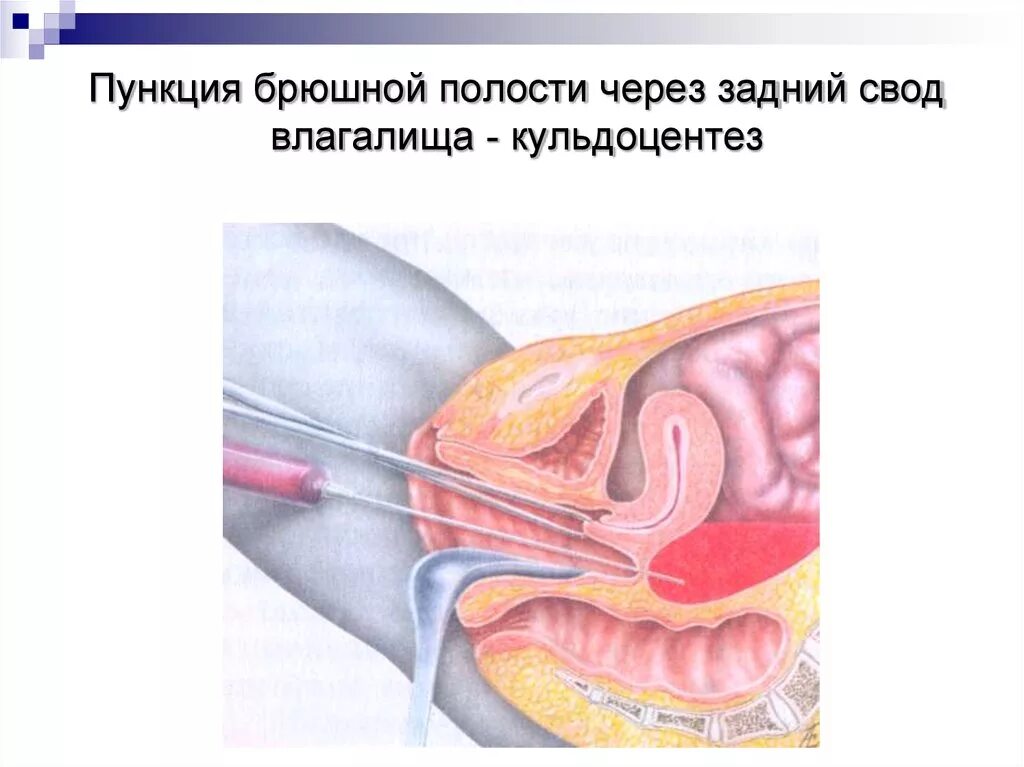 Пункция через задний свод. Пункция заднего свода влагалища (кульдоцентез). Пункция брюшной полости через задний свод влагалища картинки. Пункция брюшной полости через задний влагалищный свод. Пункция позадиматочного пространства.