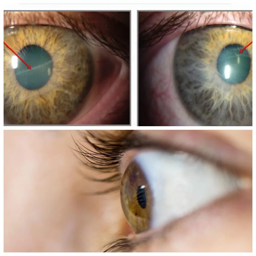 Причины глаукомы глаза. Глаукома ювенильная открытоугольная.