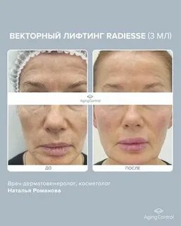 Векторный лифтинг лица что это