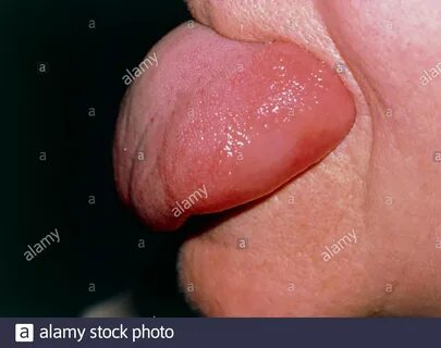 Angioedema is similar to urticaria and characterised by large Stock Photo -...