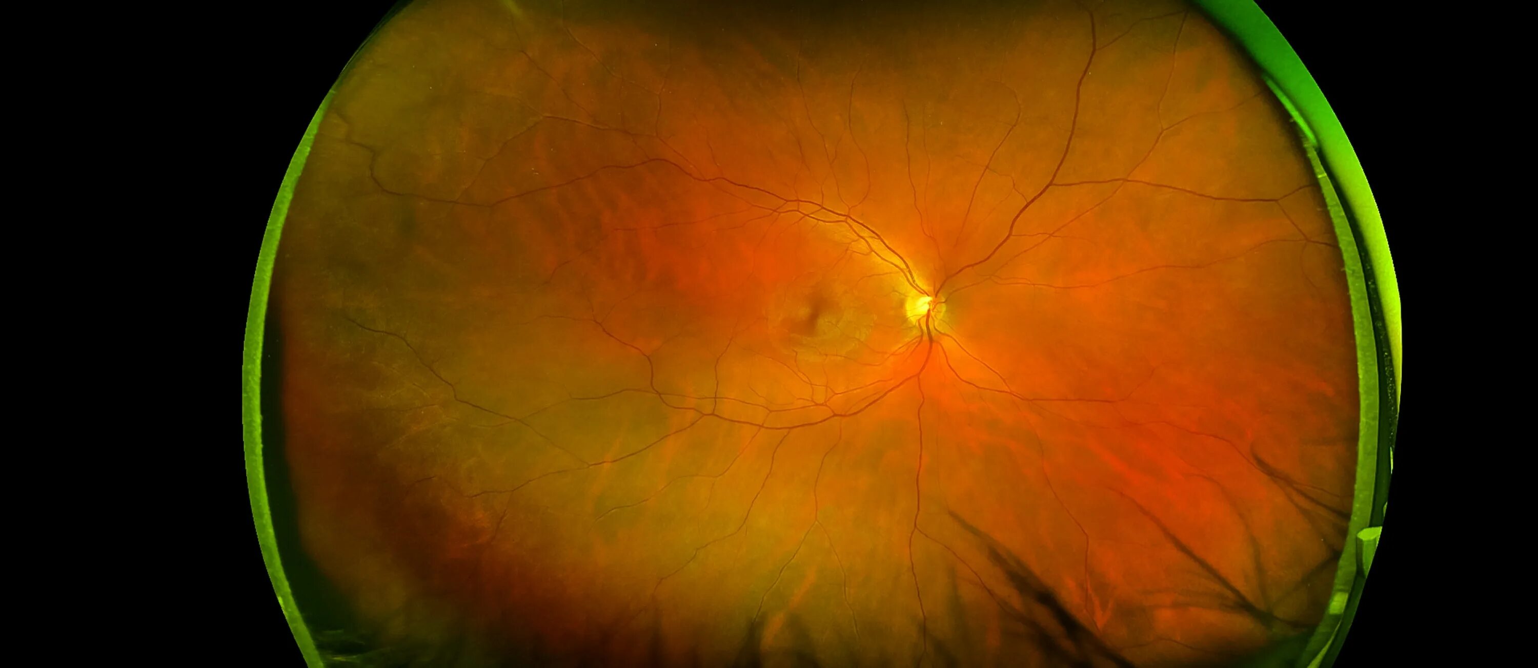 Montagen retinal platina. Астроцитарная гамартома сетчатки. Нейроофтальмопатия лебера. Ретиношизис сетчатки глаза. Возрастная макулярная дегенерация.