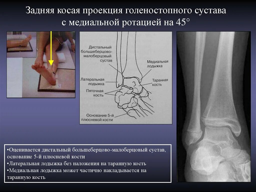 Голеностопный сустав норма. Голеностоп рентген анатомия. Синдесмоз голеностопного сустава на рентгене. Голеностопный сустав в боковой проекции. Голеностопный сустав рентген анатомия.