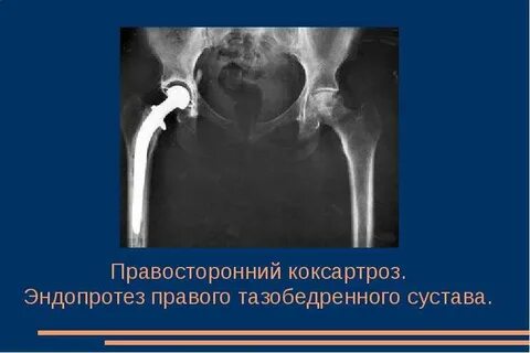 Правосторонний коксартроз