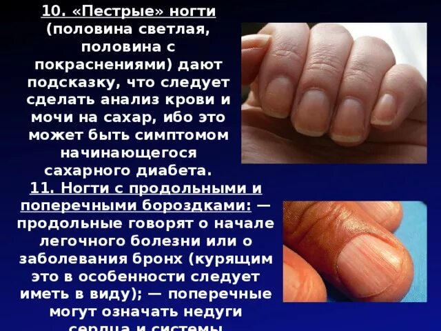 Ногти при сахарном диабете. Ногты при сахарной диабете. Ногти при сахарном диабете на руках. Пят половина