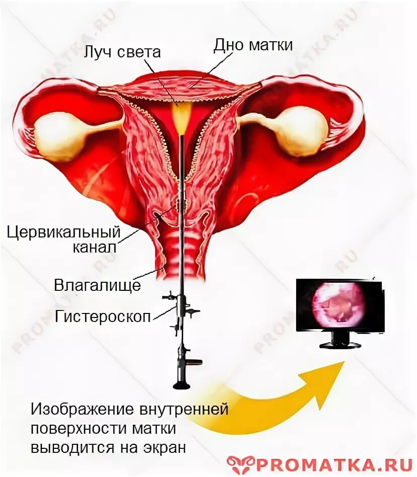 Лапароскопия полипа матки. Полип эндометрия гистероскопия. гистероскопия при полипе. гистерорезектоскопия полипа.