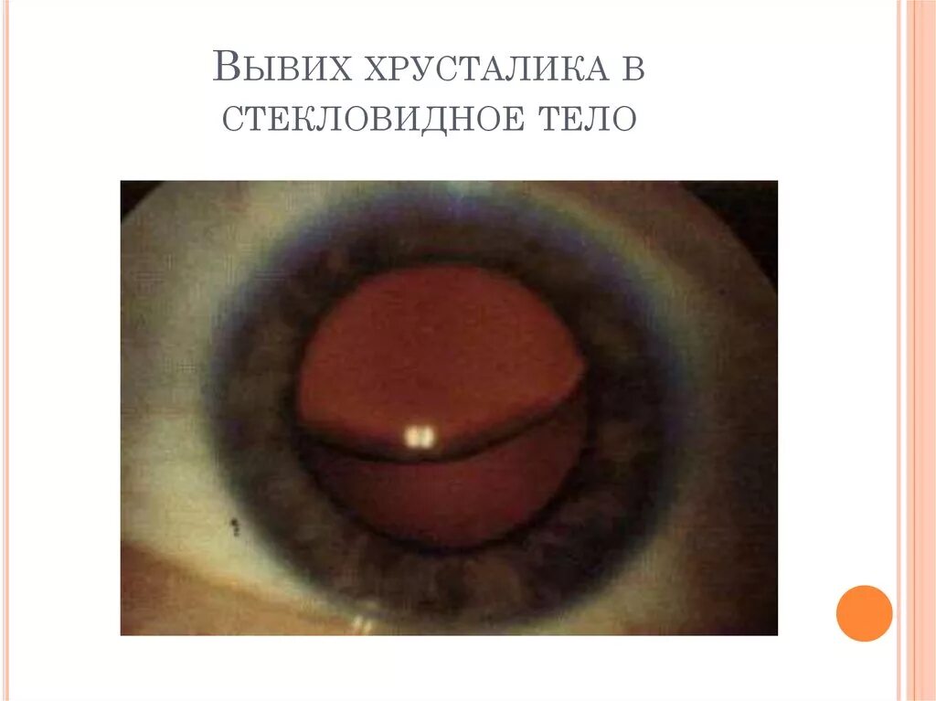 Вывих хрусталика. Люксация хрусталика в стекло. синдром марфана подвывих хрусталика. эктопия хрусталика подвывих хрусталика. врожденная дисплазия хрусталика.