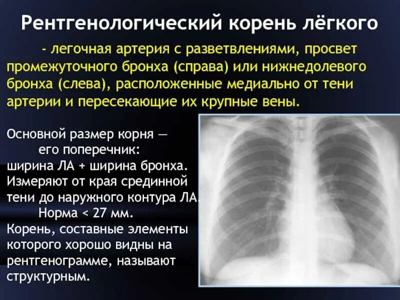 Уплотнения паренхимы по типу матового стекла