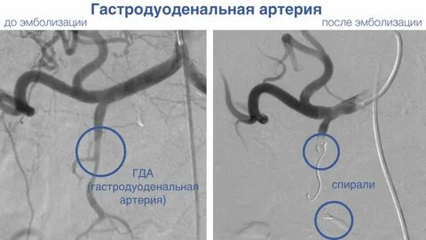 Эмболизация сосудов