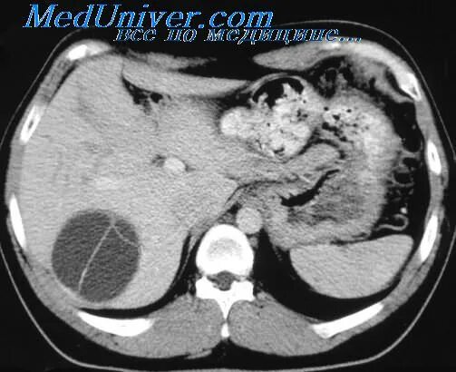 Киста селезенки мкб. Паразитарная киста селезенки на кт. Паразитарная киста печени мрт. Эпидермоидная киста селезенки. Непаразитарные кисты печени кт.