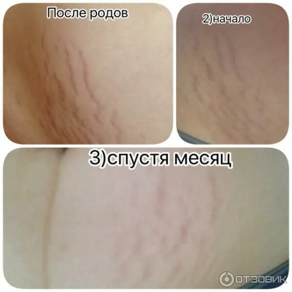 Крем от растяжек до и после. Самое лучшее средство от растяжек. Лучшее от растяжек отзывы. Мазь от растяжек до и после. Лучшее от растяжек отзывы.